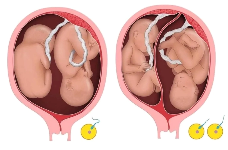 Dấu hiệu mang thai đôi 1 trai 1 gái và những điều mẹ cần biết